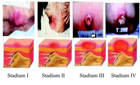 Gambar  stadium  decubitus  menurut  NPUAP  (National  Pressure Ulcer Advisory Panel) (2008) di bawah ini : 