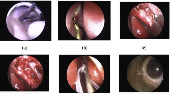 Gambar 3.2. Langkah tindakan dakriosistorhinostomi endonasal pada pasien anak  dengan fistula (a) probing dan syringing (b) insisi dengan kauter monopolar (c)  pengangkatan dan ekspose anterior lacrimal crest (d) insisi sakus lakrimal (e) pengikatan 