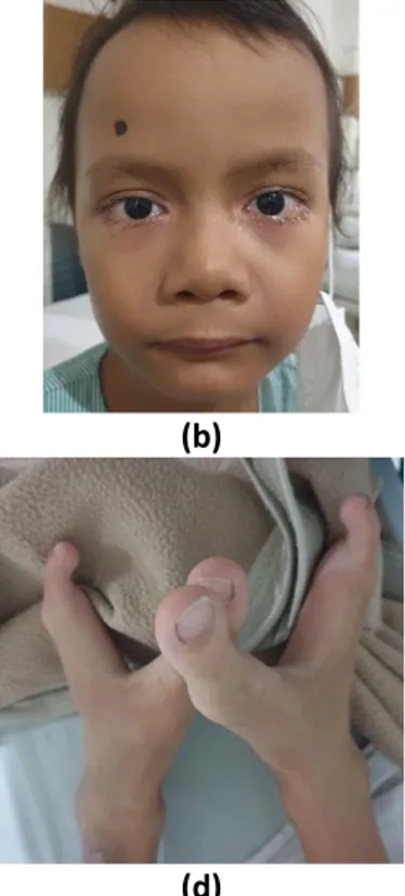 Gambar 2.1. Foto klinis  (a) ODS (b) Wajah (c) Kedua jari tangan (d) Kedua jari kaki    pada tanggal 6 Januari 2021 