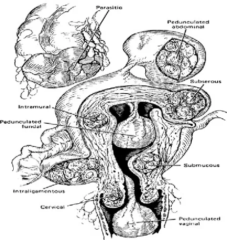 Gambar 2.1: Jenis Mioma Uteri dan lokasinya (Sumber: Martin L. Pernoll, 2001) 2.3 Epidemiologi