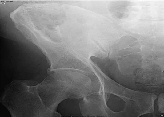 Gambar 11.  Foto Os femur, tampak lesi litik yang khas pada myeloma. 