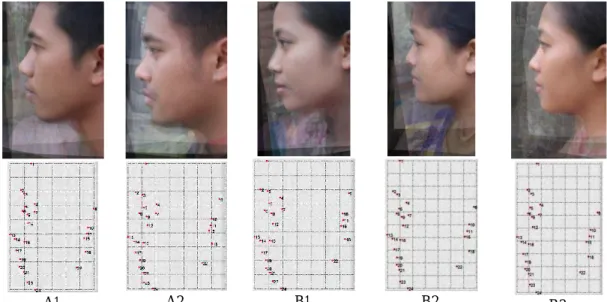 Gambar 6. Wajah bidang lateral pada laki-laki tipe I (A1), tipe II (A2) dan wajah bidang lateral pada perempuan  tipe I (B1), tipe II (B2), tipe III (B3)