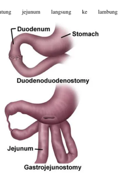Gambar  7.  Tindakan  operasi  pada  atresia  duodenum  tipe 2 (atas) dan atresia duodenum tipe 3 (bawah)  c