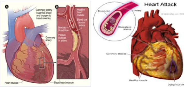 Gambar 1. Atherosclerosis pada arteri koronaria [3],[7] 