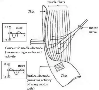 Gambar 2.13 EMG diperoleh dengan electroda jarum konsentris dan  permukaan electrode. (John R