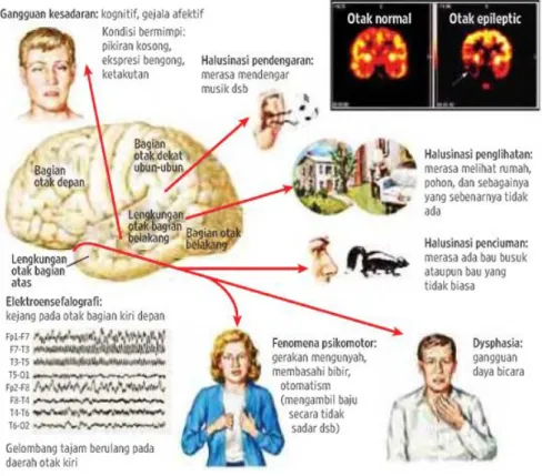 Gambar 4. Manifestasi Epilepsi Parsial Kompleks (ELSEVIER-netterimages.com)     