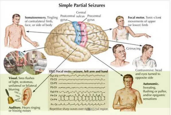 Gambar 3. Manifestasi Epilepsi Parsial Sederhana (ELSEVIER- (ELSEVIER-netterimages.com) 