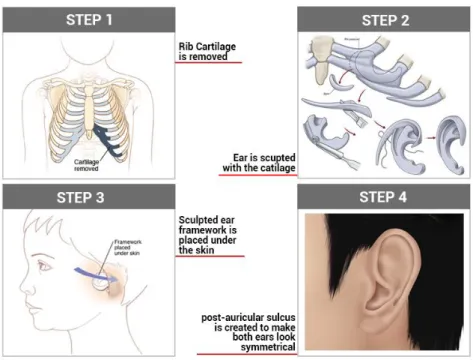 Gambar 3. Tahapan operasi microtia ear  (earreconstruction.com, 2019) 