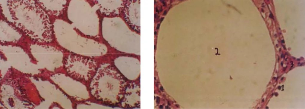 Gambar 6  . A. Histologi kerusakan  berat  tubulus seminiferus kelompok III(200x)       B
