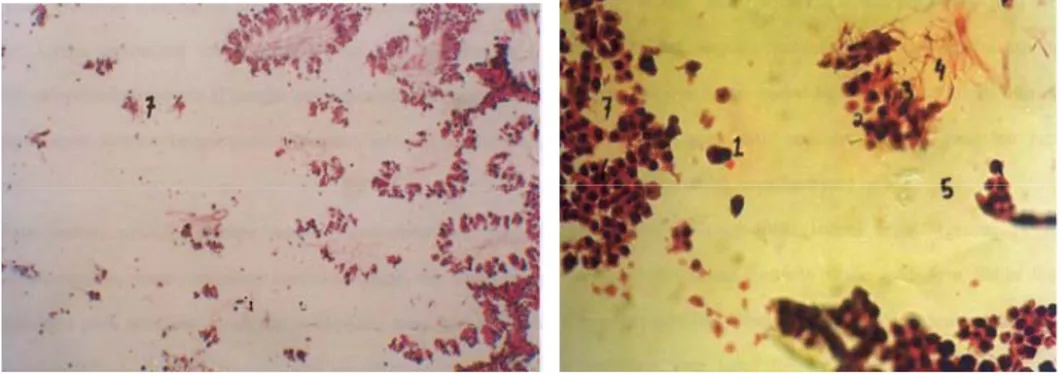 Gambar 8. A. Histologi kerusakan  berat  tubulus seminiferus kelompok IV(200x)                    B