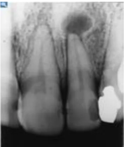 Gambar 2.1 Gambaran Radiografik Granuloma periapikal  (Hollender , Omnell. 2008. dental radiology pathology) 