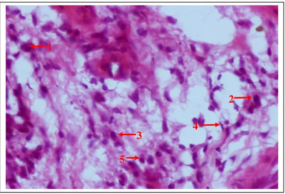 Gambar  3.1  Jaringan  granuloma  ditemukan  sel  datia  (1),  limfosit  (2),  makrofag (3), Fibroblas (4) dan Sel plasma (5)(HPA 400X)