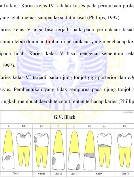 Gambar 2.4 Klasifikasi Karies Dr. G. V. Black 