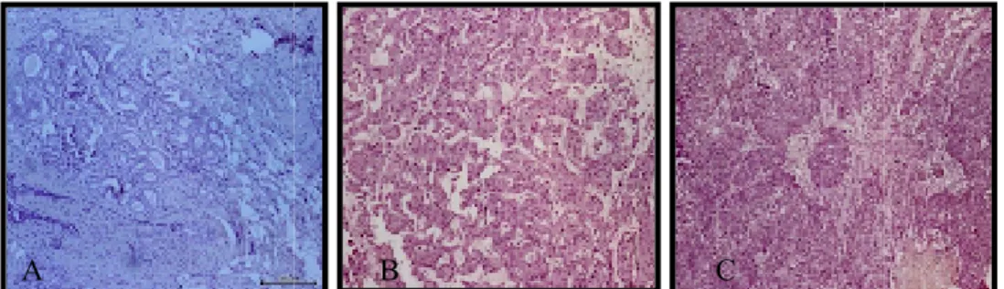 Gambar  5.1  Hasil  pemeriksaan  histopatologi  konvensional  duktal  invasif  tipe  tidak  spesifik