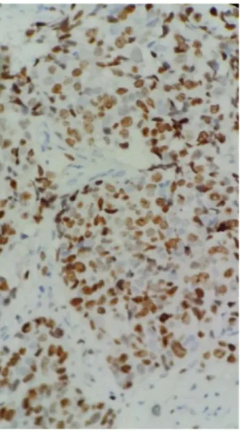 Gambar  2.8    :Imunohistikimia  Ki-67  A.Low  Proliferasi,  B.  High  Proliferasi  (Sumber  :  Laboratorium Patologi Anatomi RSUP H