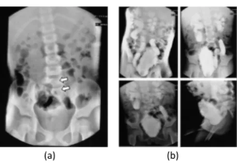 Gambar 2. Pemeriksaan Voiding cystouretrogram: (a) Pada foto polos tampak gambaran spina bifida pada vertebra L 5 dan S 1 (tanda panah); (b) Tampak ureter kanan-kiri lebar dan  berkelok-kelok serta kalik dan pelvis renalis yang sangat lebar (refluks vesiko