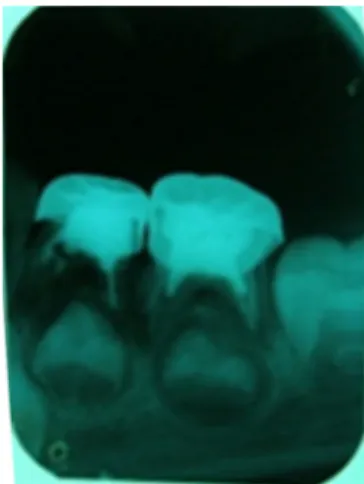 Gambar 2. Pengisian dengan ZOE telah dilakukan pada  gigi 74