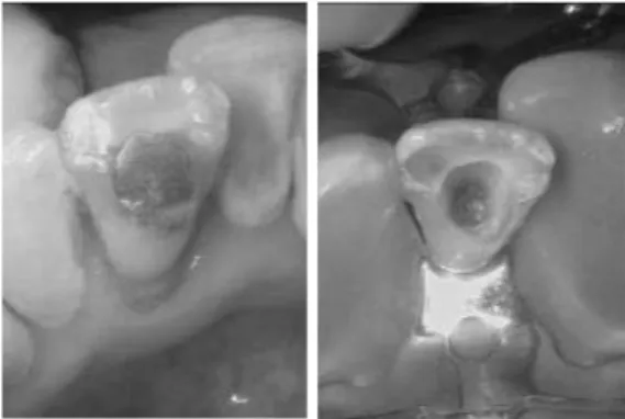 Gambar 2.  Foto klinis pembukaan akses gigi 31. Gambar 3. Foto radiografi k gigi 31 setelah pengambilan gutaperca  perawatan sebelumnya dan pencapaian panjang kerja  ideal.