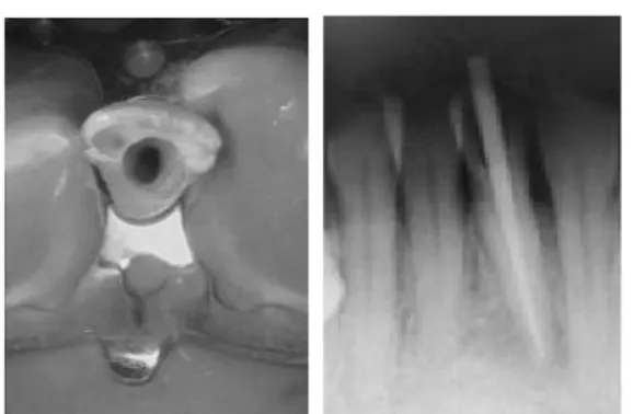 Gambar 6.  Foto klinis gigi 31 sebelum dan setelah bleaching intra  korona.