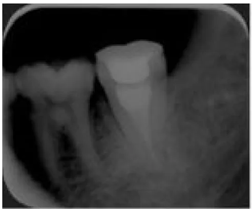 Gambar 4: gambaran intraoral                      Gambar 5. gambaran radiografis kontrol                         3 bulan pasca PSA 