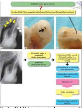 Gambar 11 A Molar pertama atas dengan periodontitis  kronis  parah  disertai  kegoyangan ,   B  dan  C  setelah  ekstraksi,  1/3  apikal  akar  dipotong  horisontal
