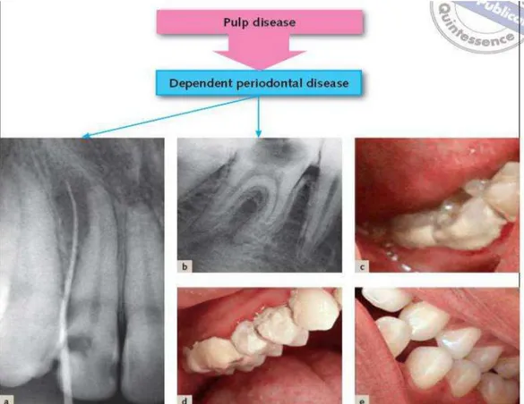 Gambar  3  Etiopatogenesis  lesi  endo  dengan  keterlibatan  perio;  A  Penyakit  periodontal  dengan  pembentukan  sinus  dapat  disebabkan  oleh  pulpa  nekrosis  karena  karies,  B  gigi  molar  pertama  bawah  dengan  karies  mencapai  pulpa  dan  per
