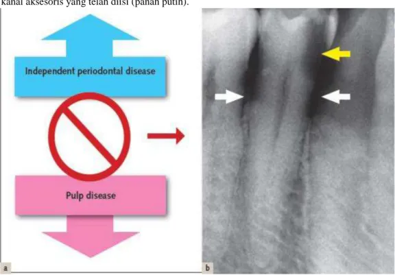 Gambar  5  A  Diagram  skematis  etiopatogenesis  lesi  endoperio  independen,  B  lesi  endoperio  independen dengan etiologi berbeda (panah kuning menunjukkan karies mencapai pulpa, panah  putih menunjukkan periodontitis marginalis)
