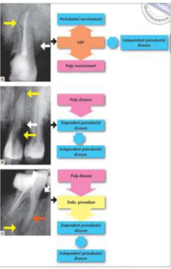 Gambar 9 Etiopatogenesis lesi endoperio lanjut dengan  Diagnosis definitif baru dapat ditegakkan setelah  penyakit  periodontal  independen