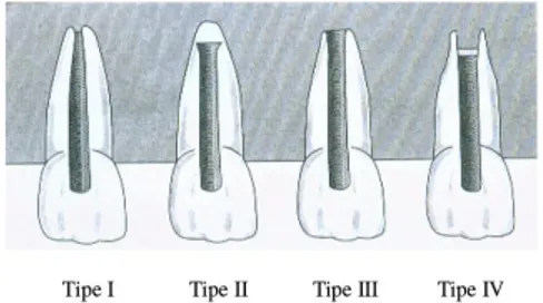 Gambar 1. Berbagai bentuk penutupan apeks setelah perawatan apeksifikasi (diambil  dari: Weine FS