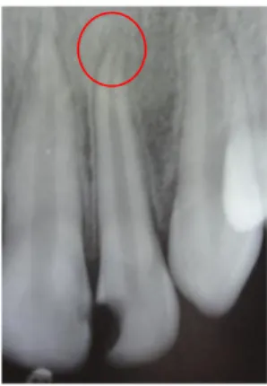 Gambar  2.  Hasil  radiografi  periapikal  yang  diambil  15  Mei  2010,  tampak  ujung  akar  gigi  22    yang  belum  menutup   sem-purna