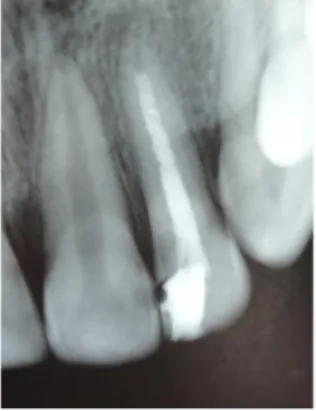 Gambar 3. Pada ronsen foto tampak pasta kalsium hidroksid yang mengisi saluran akar  pada gigi 22 yang ujung akarnya belum menutup sempurna