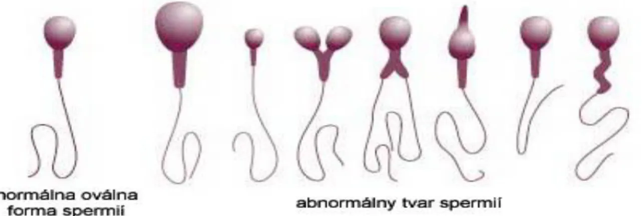 Gambar 3 : bentuk morfologi sperma normal dan abnormal pada manusia 