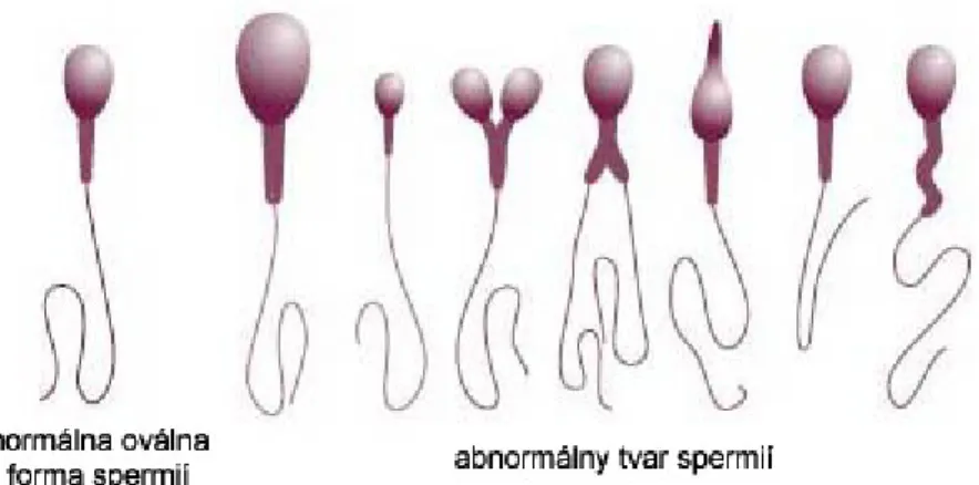 Gambar 2. Contoh struktur sperma normal dibandingkan dengan yang  abnormal  (sumber: http://www.sanatoriumhelios.sk/en/infertility)