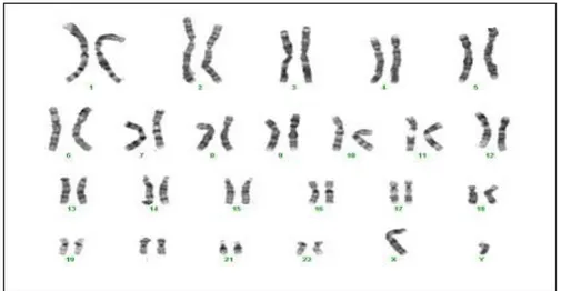Tabel  1  memperlihatkan  hasil  pemeriksaan  kromosom  pada  30  orang  sampel penelitian adalah normal, yaitu semua  memiliki  kariotip  46XY  dan  pada  sampel  tidak  ditemukan  aberasi  struktur  kromosom  Y
