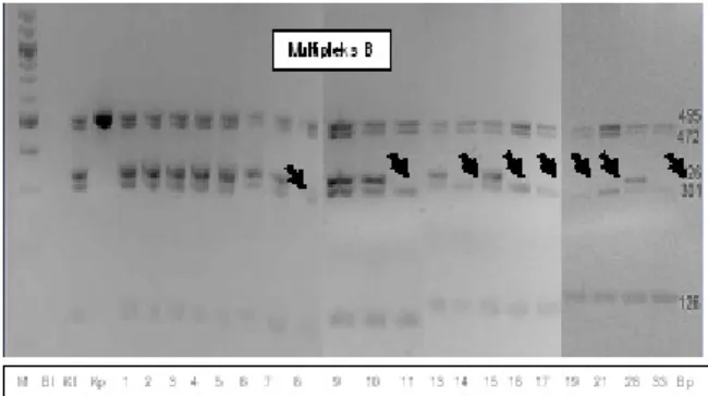 Gambar 1. Gambaran produk hasil PCR elektroforesis gen SRY dan AZF dengan primer Multipleks A