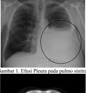 Gambar 1. Efusi Pleura pada pulmo sinitra.