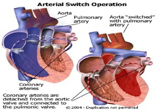 Gambar 22-7 Skema operasi pertukaran arteri untuk transposisi arteri besar.