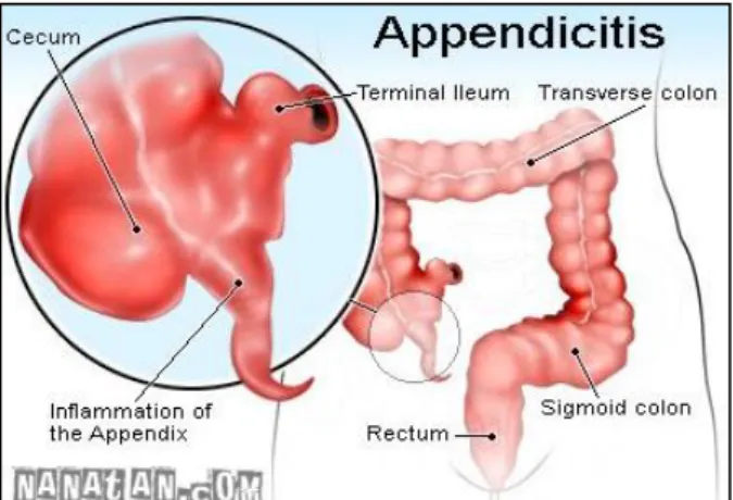 Gambar 3.2 Peradangan pada apendiks vermiformis 