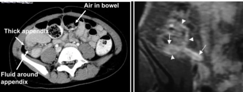 Gambar 8. CT-scan Appendiks (kiri) dan USG Appendiks (kanan)  3.  Analisa urin  