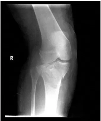 Gambar 7.  Ini adalah X-Ray dari fraktur tibial plateau. Pasien adalah wanita usia 55 tahun yang  jatuh dengan lutut terlebih dahulu ketika berkebun