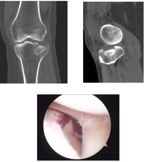 Gambar 8.  CT-scan Posisi AP, sagital, serta arthtroscopy menunjukkan fraktur kompres lateral