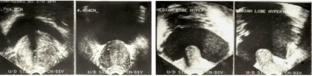 Gambar 7. Gambaran Sonografi Prostat Normal