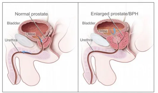 Gambar 3. Benign Prostat Hyperplasia 