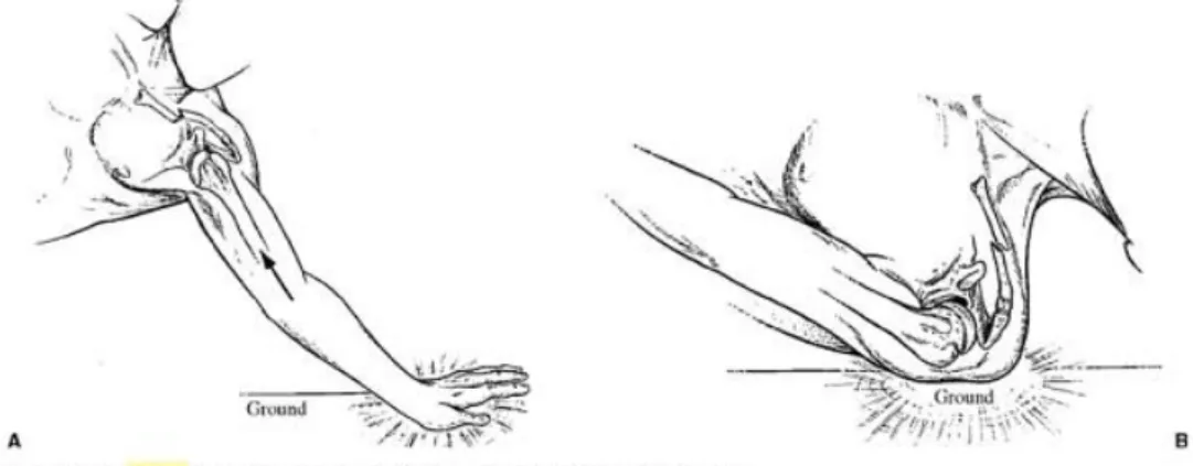 Gambar 4 : Mekanisme jatuh pada fraktur clavicula ( Zuckerman 2011)