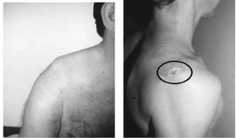 Gambar 5: Deformitas dan Jejas pada fraktur clavicula ( Wiss 2013) 4. Bahu dan lengan terasa lemah, mati rasa, dan kesemutan