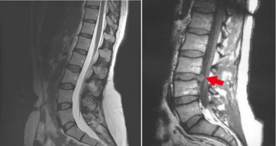 Gambar  6.  MRI  dari  columna  vertebralis  normal  (kiri)  dan  mengalami herniasi (kanan) 
