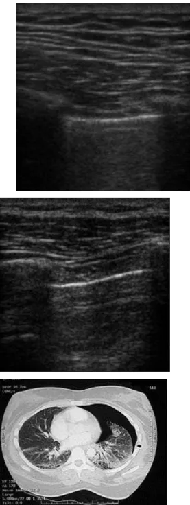 Gambar 7 Video Anatomi Normal  Lung sliding back and forth 