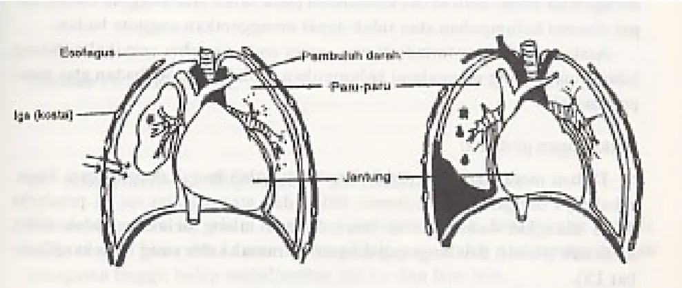 Gambar 4. Kiri, menunjukkan robeknya pleura karena tertusuk patahan  tulang iga (pneumothoraks)