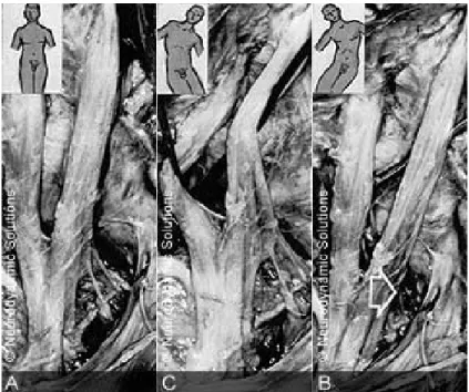 Gambar 9. Diseksi gerakan di dalam pelvis pada komponen proksimal dari saraf  sciatica sepanjang gerak fleksi lateral tulang belakang bagian lumbal
