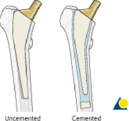 Gambar 6. Perbedaan uncemented dan cemented total hip arthroplasty 